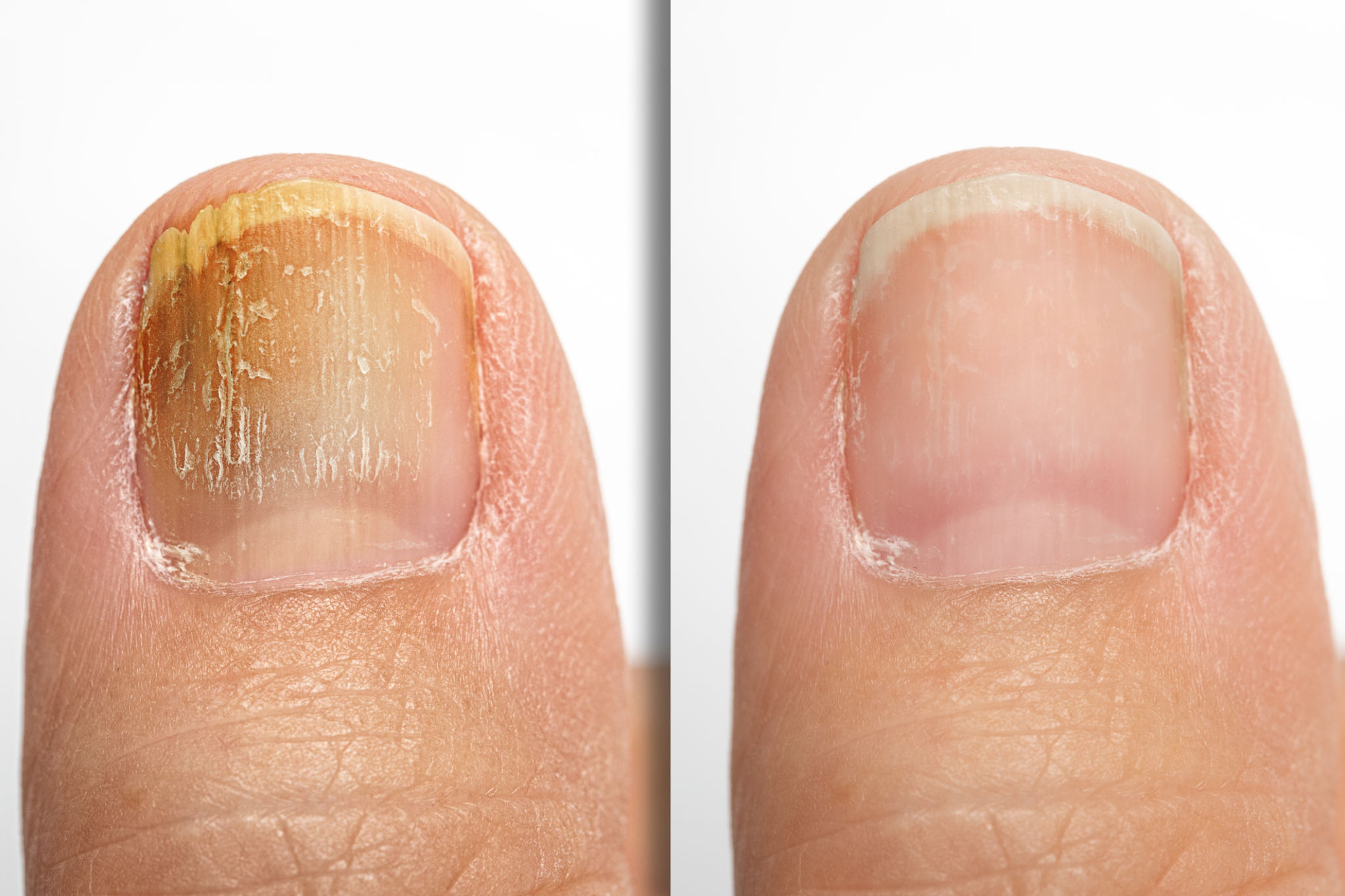 before and after nails