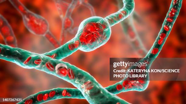 microaneurysms, illustration - diabetic retinopathy stock illustrations