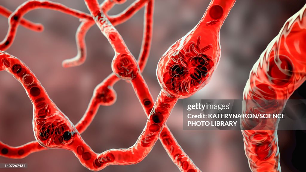 Microaneurysms, illustration