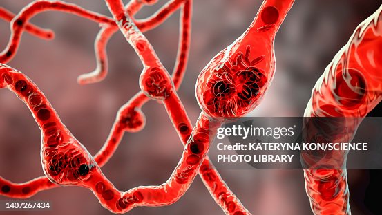 Microaneurysms, illustration Microaneurysms, illustration