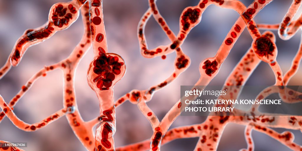 Microaneurysms, illustration