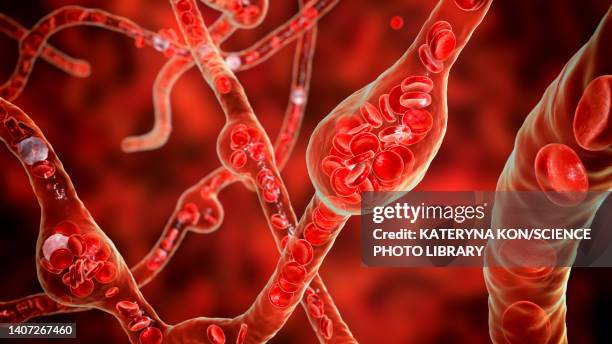 ilustraciones, imágenes clip art, dibujos animados e iconos de stock de microaneurysms, illustration - indicador de presión sanguínea