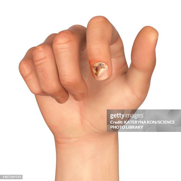 illustrations, cliparts, dessins animés et icônes de fungal nail infection, illustration - onychomycose