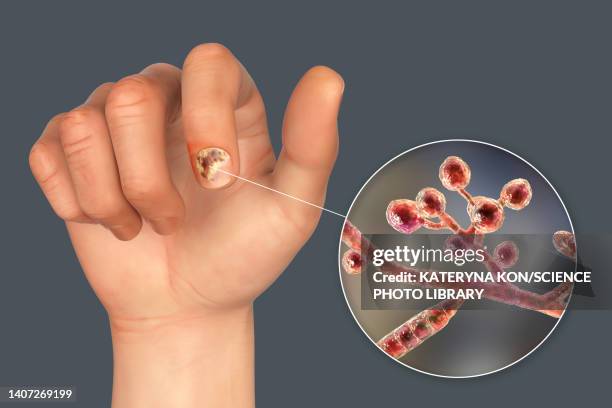 fungal nail infection, illustration - onychomycosis stock illustrations