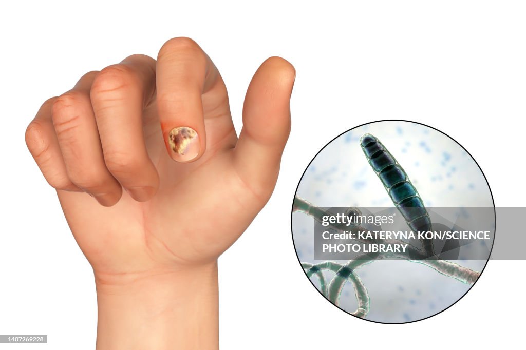 Funga Lightning Fungal Nail Infection
