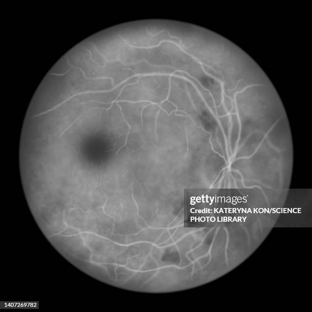 retina damage from diabetes, illustration - diabetic retinopathy stock illustrations