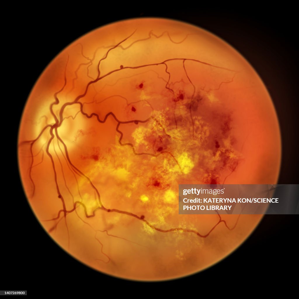 Retina damage from diabetes, illustration