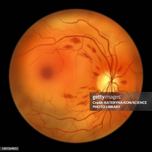 ilustrações, clipart, desenhos animados e ícones de retina damage from diabetes, illustration - retinopatia diabética