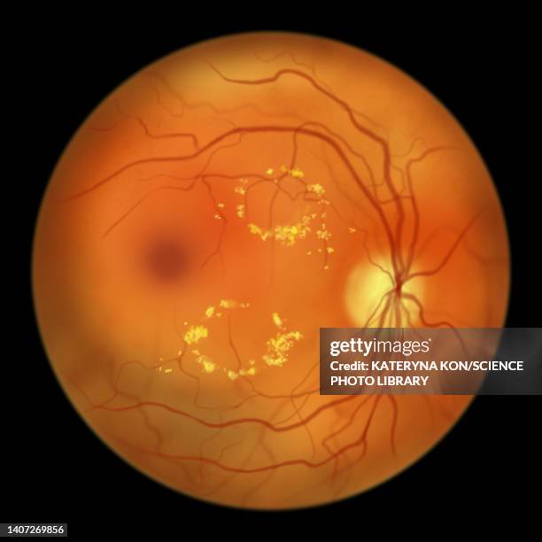retina damage from diabetes, illustration - retinopathy stock illustrations