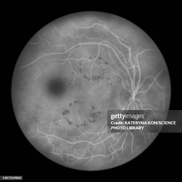 retina damage from diabetes, illustration - eye disease stock illustrations