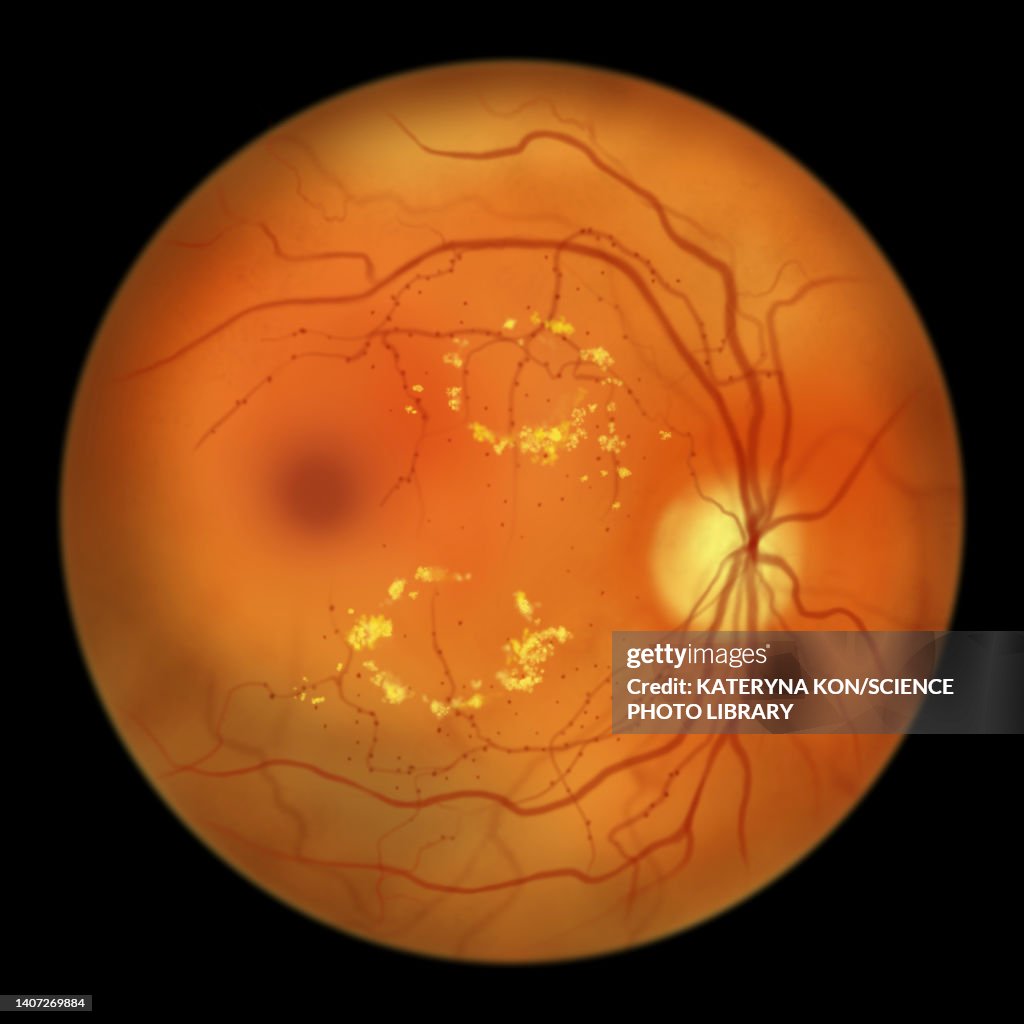 Retina damage from diabetes, illustration