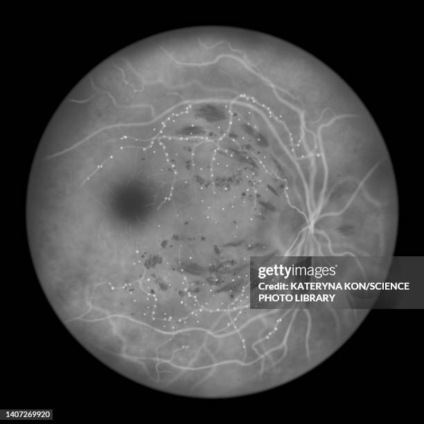 retina damage from diabetes, illustration - diabetic retinopathy stock-grafiken, -clipart, -cartoons und -symbole