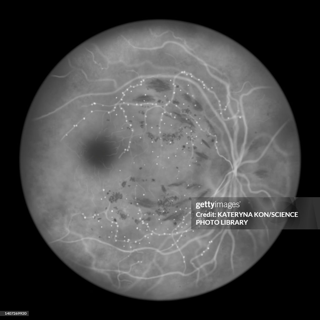 Retina damage from diabetes, illustration