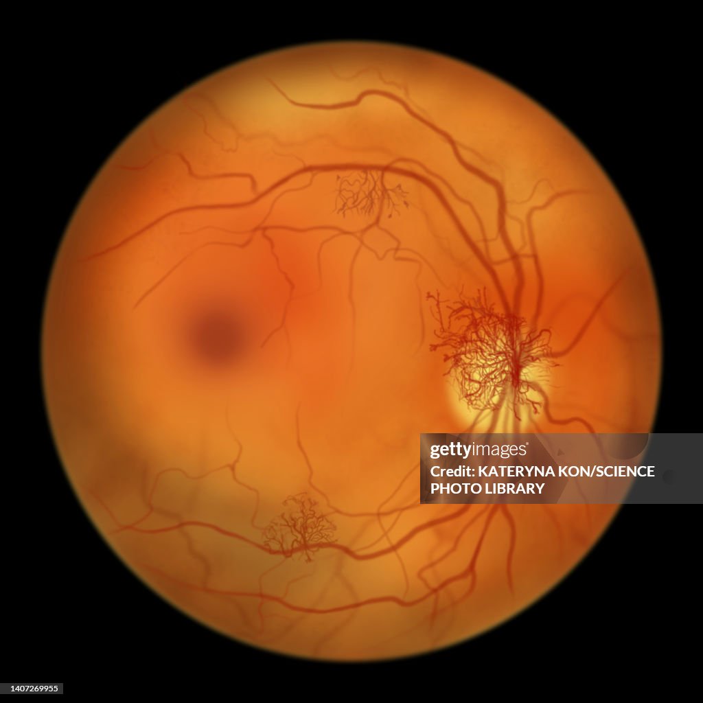 Retina damage from diabetes, illustration