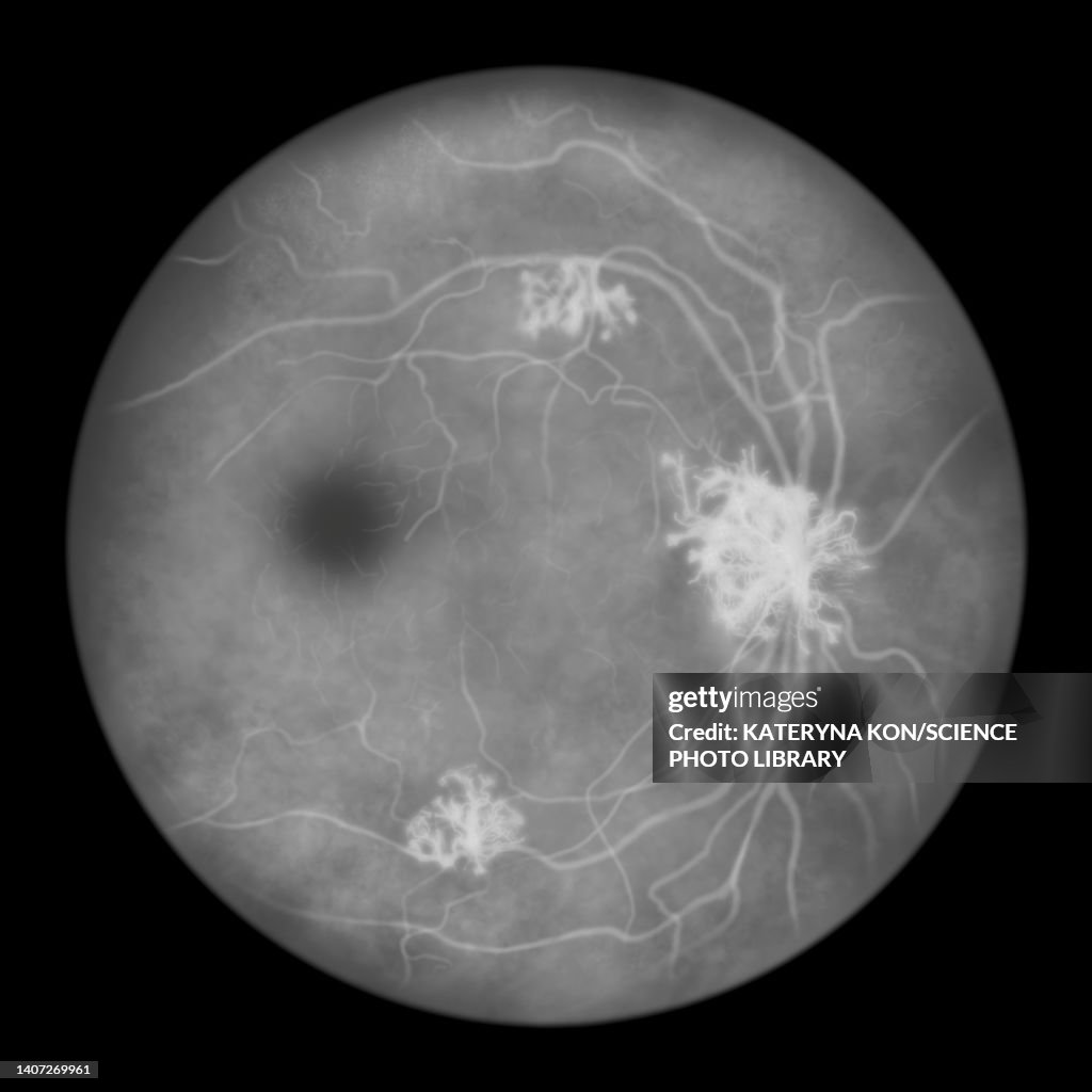 Retina damage from diabetes, illustration