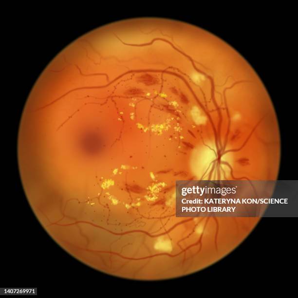 ilustrações, clipart, desenhos animados e ícones de retina damage from diabetes, illustration - diabetic retinopathy