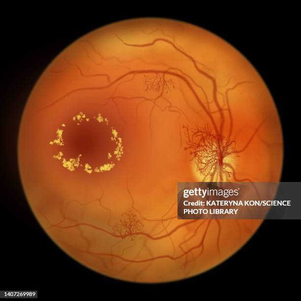 ilustrações, clipart, desenhos animados e ícones de retina damage from diabetes, illustration - retinopatia diabética