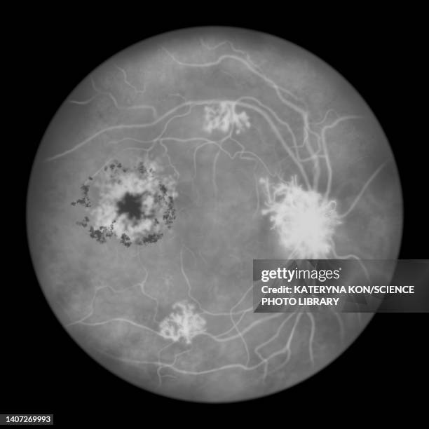 retina damage from diabetes, illustration - diabetic retinopathy stock-grafiken, -clipart, -cartoons und -symbole