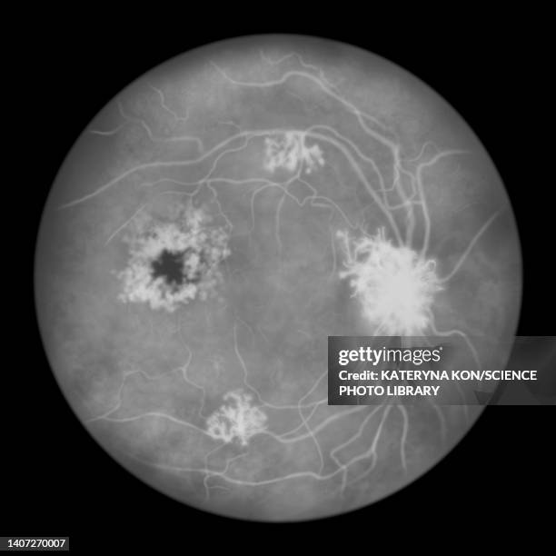 retina damage from diabetes, illustration - diabetic retinopathy stock-grafiken, -clipart, -cartoons und -symbole