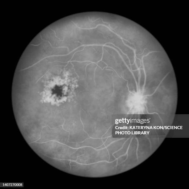 retina damage from diabetes, illustration - diabetic retinopathy stock-grafiken, -clipart, -cartoons und -symbole