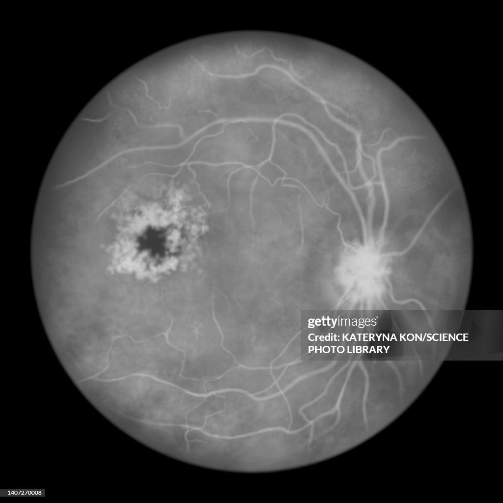 Retina damage from diabetes, illustration