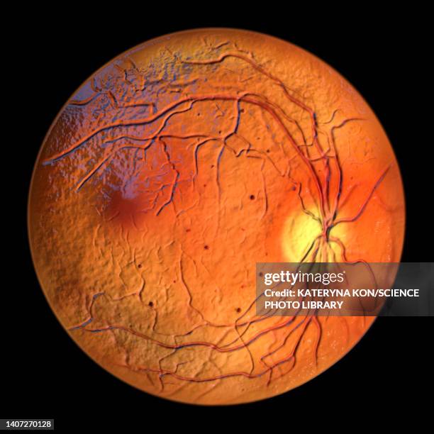 ilustrações, clipart, desenhos animados e ícones de retina damage from diabetes, illustration - retinopatia diabética