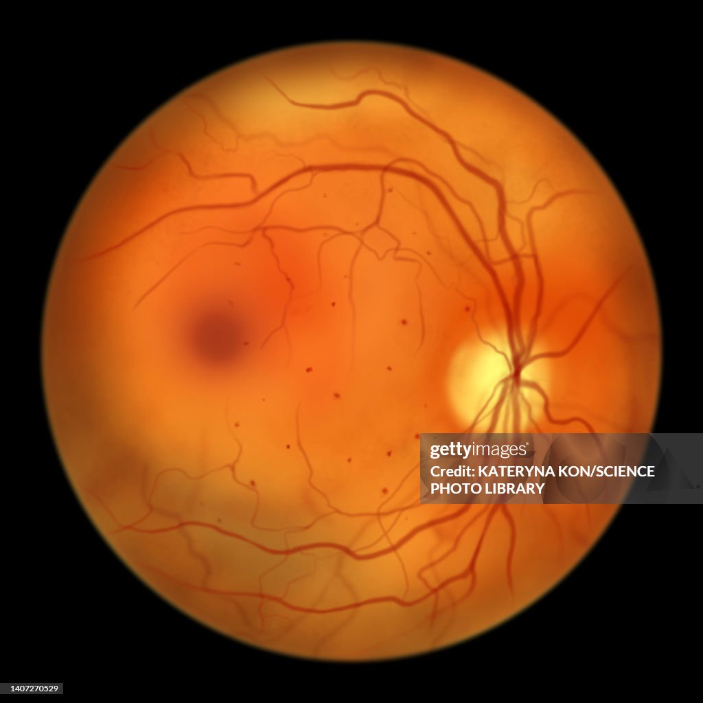 Retina damage from diabetes, illustration
