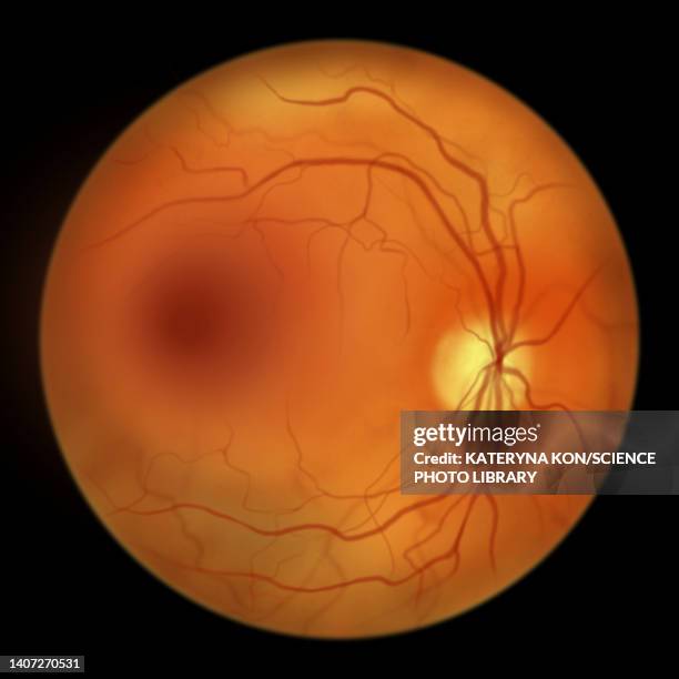 retina damage from diabetes, illustration - diabetic retinopathy stock-grafiken, -clipart, -cartoons und -symbole