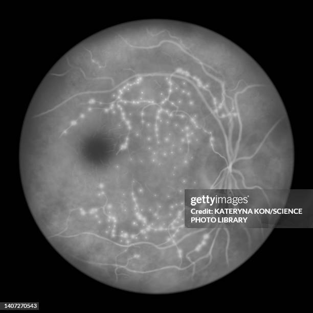 retina damage from diabetes, illustration - diabetic retinopathy stock-grafiken, -clipart, -cartoons und -symbole