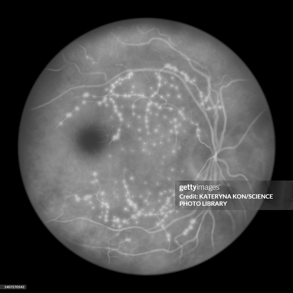 Retina damage from diabetes, illustration