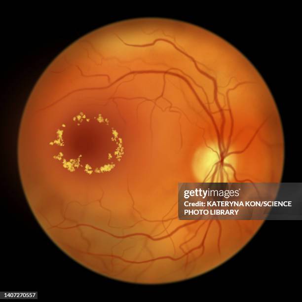 retina damage from diabetes, illustration - diabetic retinopathy stock-grafiken, -clipart, -cartoons und -symbole