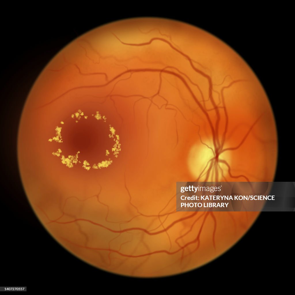 Retina damage from diabetes, illustration