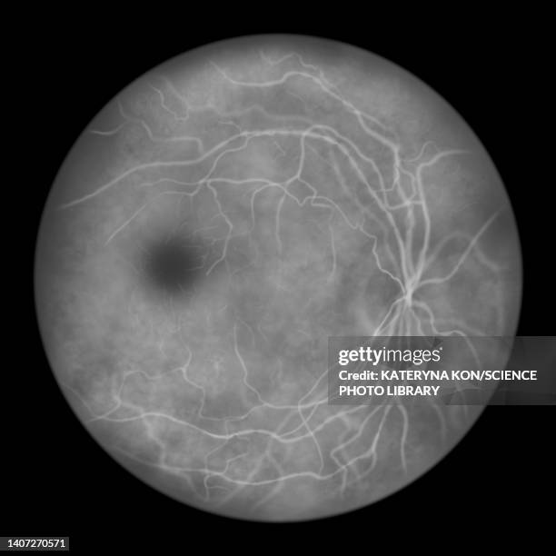 retina damage from diabetes, illustration - arteriography stock illustrations