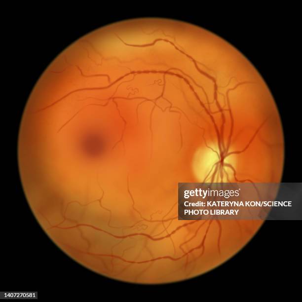 retina damage from diabetes, illustration - fundus stock illustrations