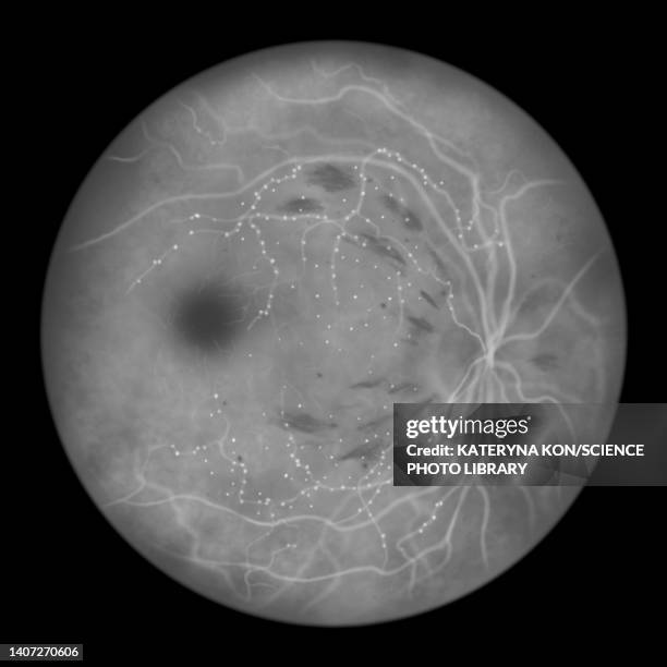 retina damage from diabetes, illustration - aneurysm stock illustrations