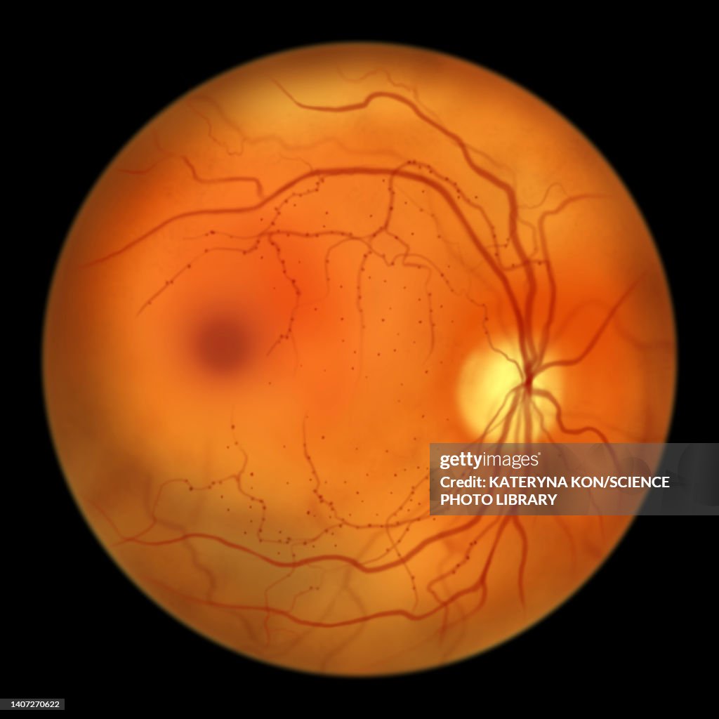 Retina damage from diabetes, illustration