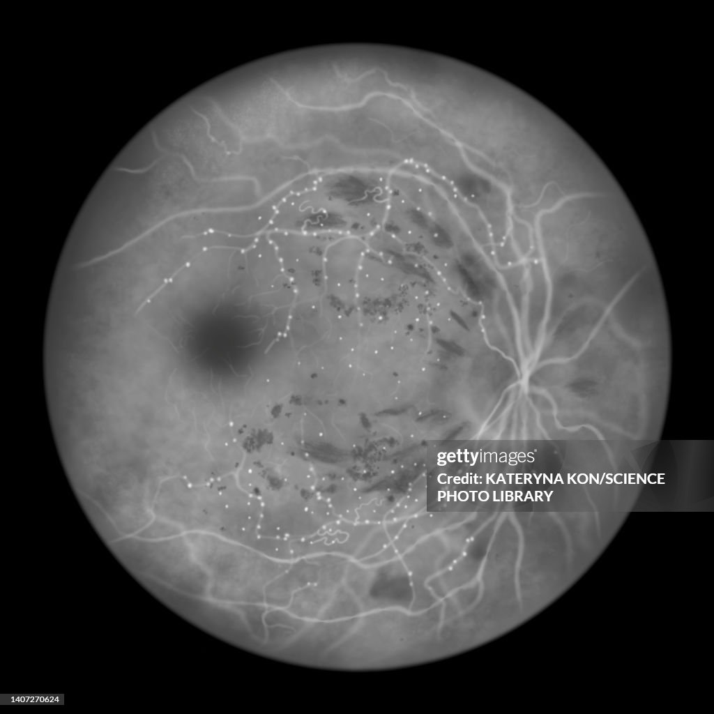 Retina damage from diabetes, illustration