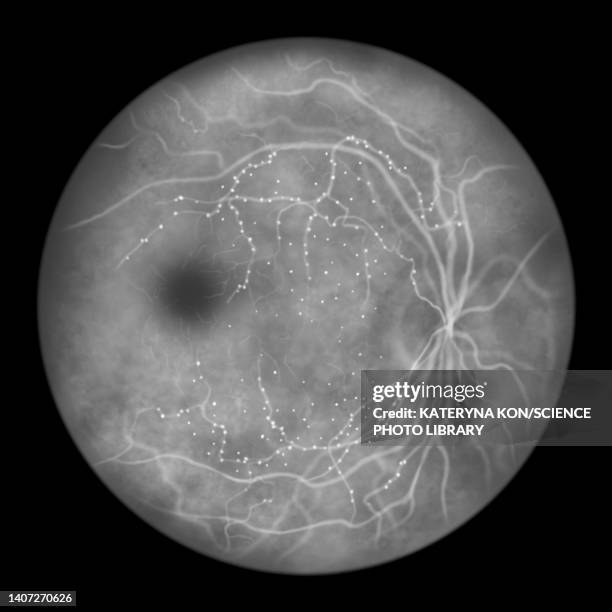retina damage from diabetes, illustration - aneurysm stock illustrations