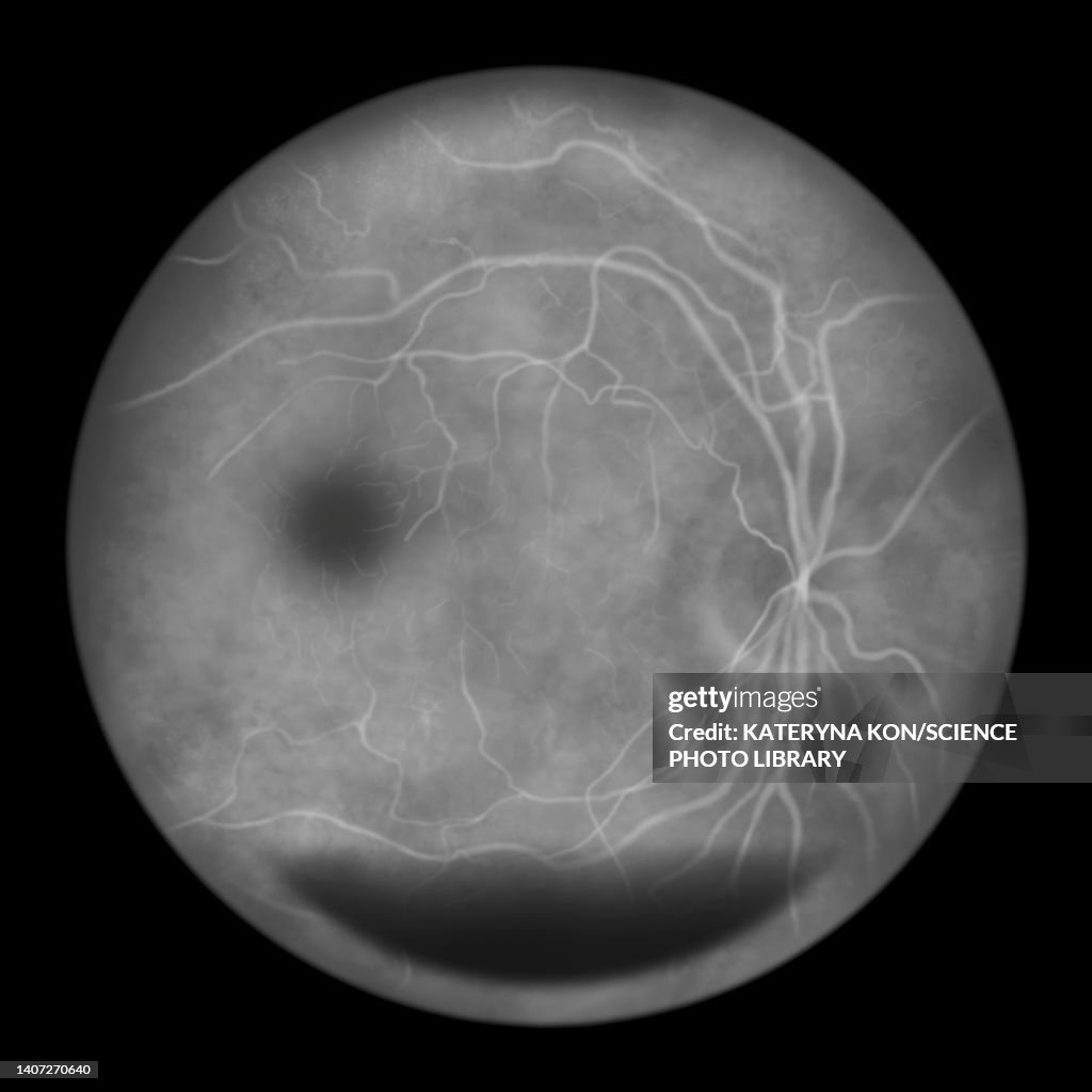 Retina damage from diabetes, illustration