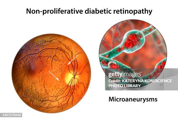 ilustrações, clipart, desenhos animados e ícones de retina damage from diabetes, illustration - retinopatia diabética