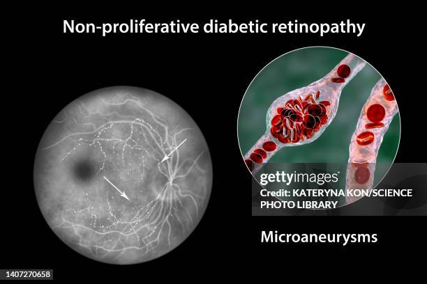 retina damage from diabetes, illustration - diabetic retinopathy stock-grafiken, -clipart, -cartoons und -symbole