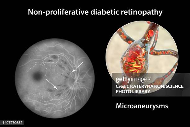 ilustrações, clipart, desenhos animados e ícones de retina damage from diabetes, illustration - diabetic retinopathy