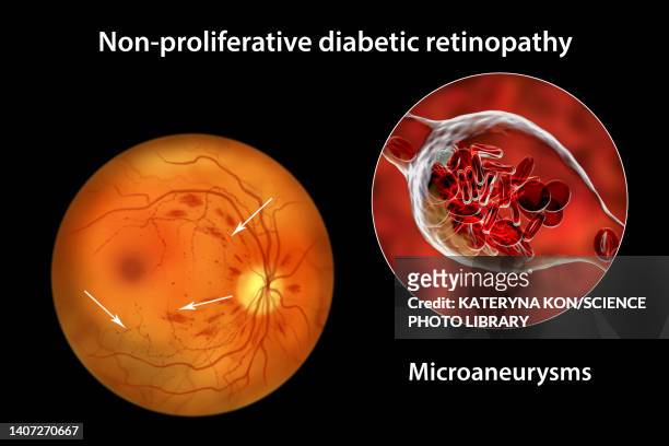 ilustrações, clipart, desenhos animados e ícones de retina damage from diabetes, illustration - retinopatia diabética