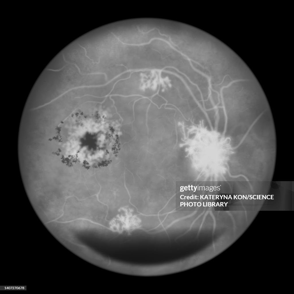 Retina damage from diabetes, illustration