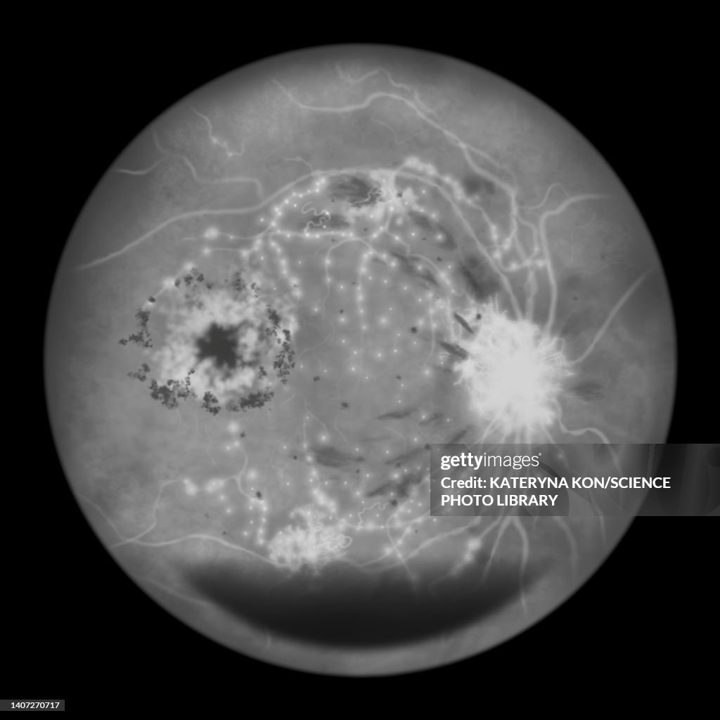 Retina damage from diabetes, illustration