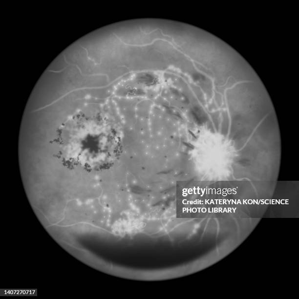 ilustrações, clipart, desenhos animados e ícones de retina damage from diabetes, illustration - retinopatia diabética