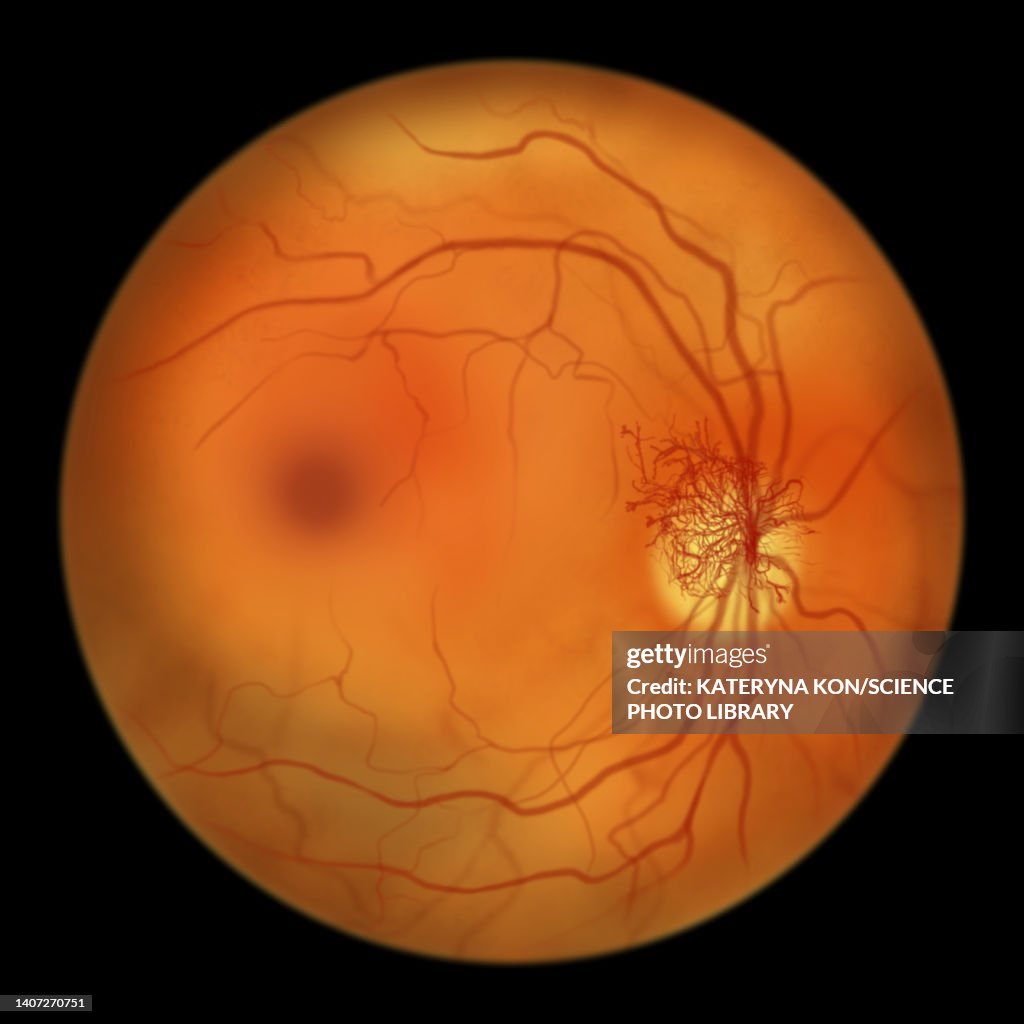 Retina damage from diabetes, illustration