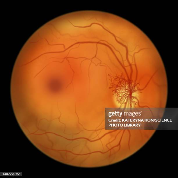 retina damage from diabetes, illustration - diabetic retinopathy stock-grafiken, -clipart, -cartoons und -symbole