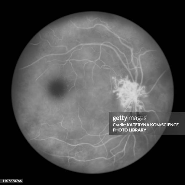 retina damage from diabetes, illustration - diabetic retinopathy stock-grafiken, -clipart, -cartoons und -symbole
