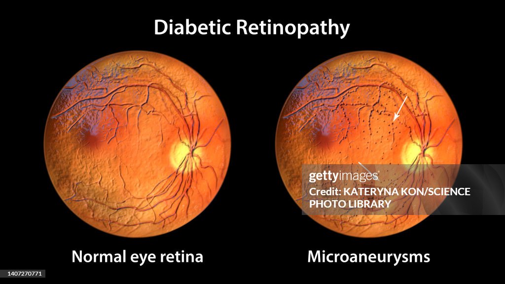 Retina damage from diabetes, illustration